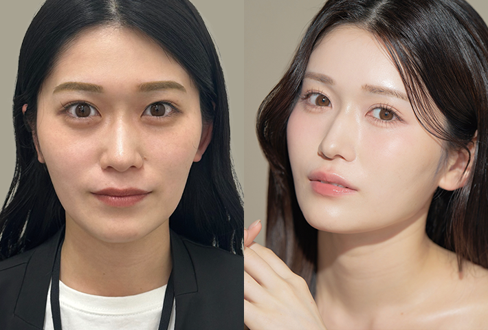 Before After 症例2