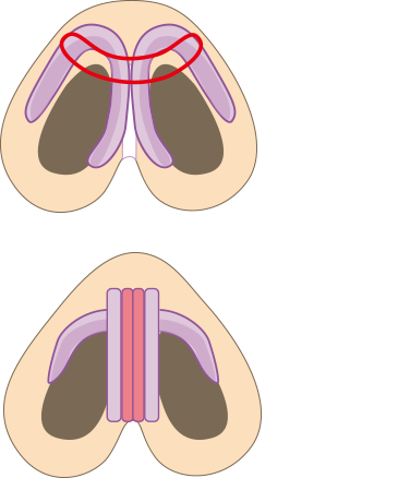 鼻尖形成と鼻尖3D法との違い