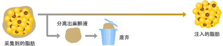 通常の脂肪注入説明イラスト