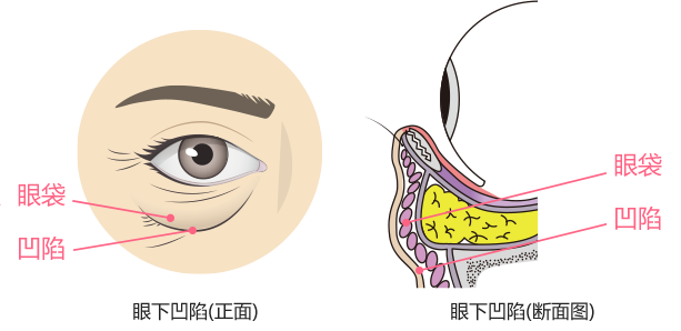 目の下は膨らみと凹みが混在