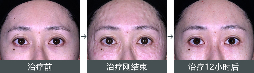 女優注射<sup>®</sup>~リジュラン+ボトックス~ ダウンタイムの症例