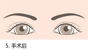 5.手术后