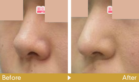 鼻中隔延長術の症例写真3