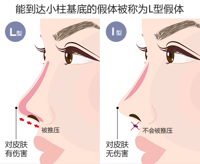 鼻の付け根までプロテーゼがくるものをL型と呼ぶ