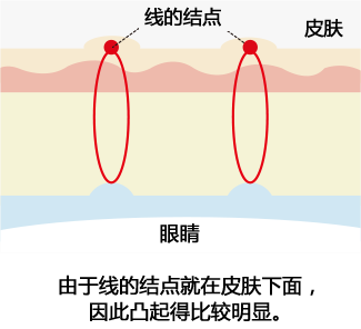 通常の埋没法