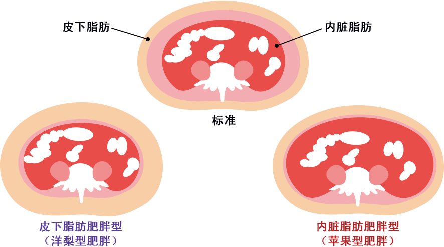 皮下脂肪型肥満と内臓脂肪型肥満