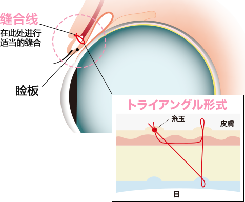 週末二重術とは