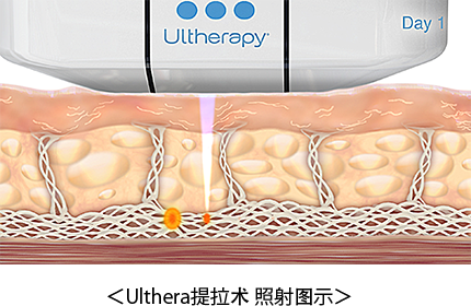 ＜ Ulthera提拉术 照射图示＞