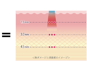 高频 + 光学、激光治疗