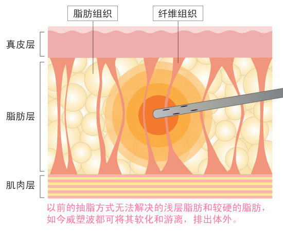 皮下脂肪の90％を除去する高い効果 画像02