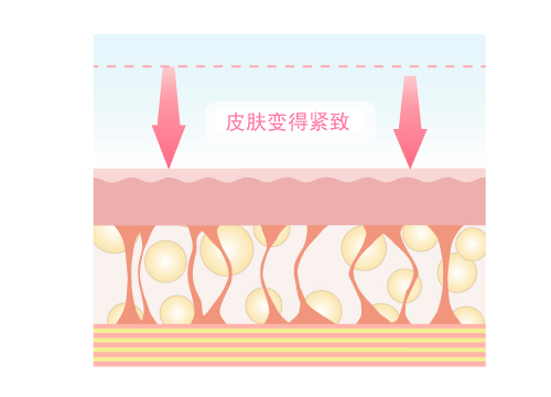 皮膚をタイトニング(引き締め) 画像