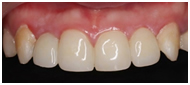 フルジルコニアの歯の画像